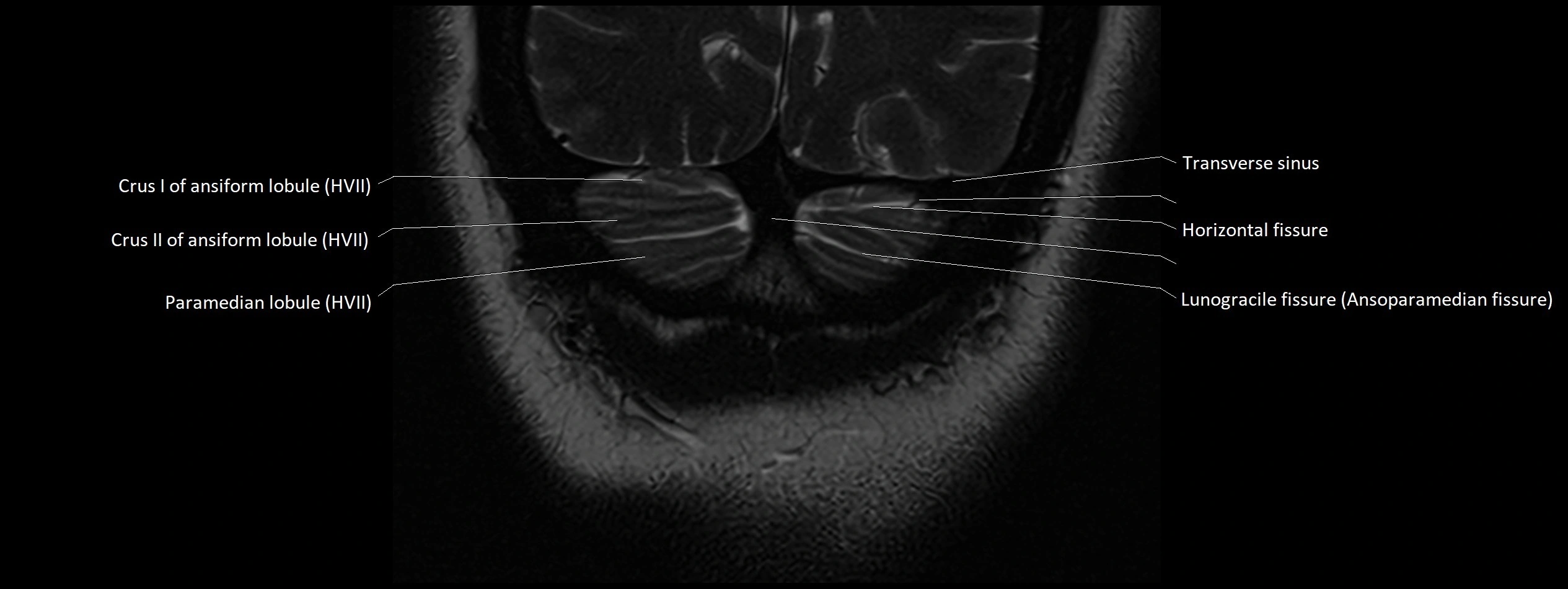 Anatomy of cerebellum coronal cross sectional 3T image 31.webp